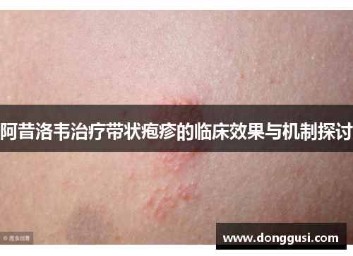 阿昔洛韦治疗带状疱疹的临床效果与机制探讨